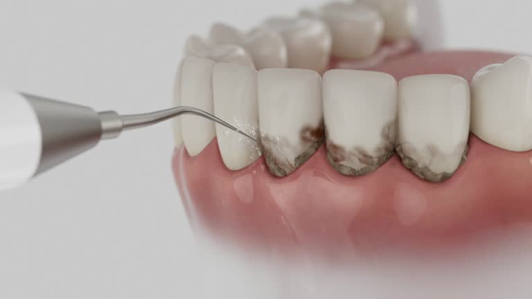 Trusted Wisdom Tooth Removal service in Woodridge, IL - Dentist Open Now